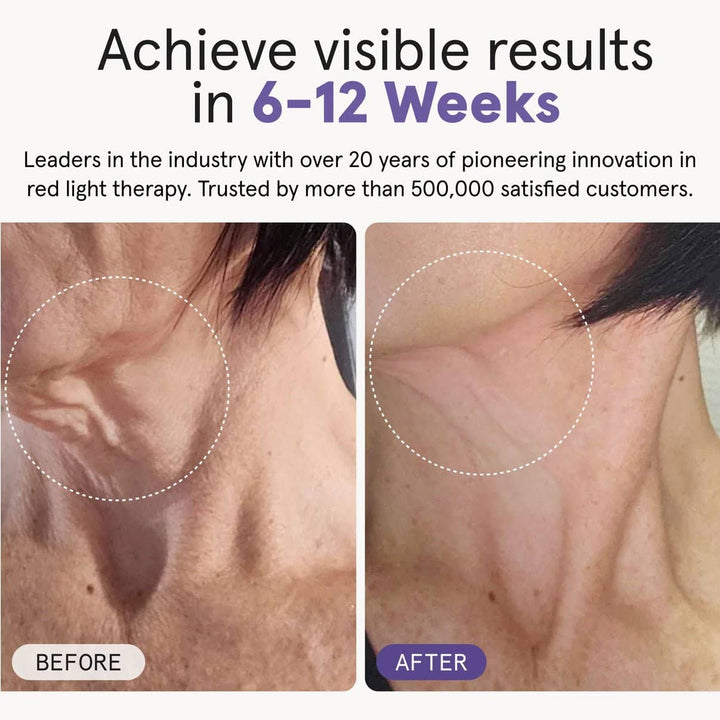 iRestore Illumina LED Neck &amp; Chest Mask - My Luxury Home Spa