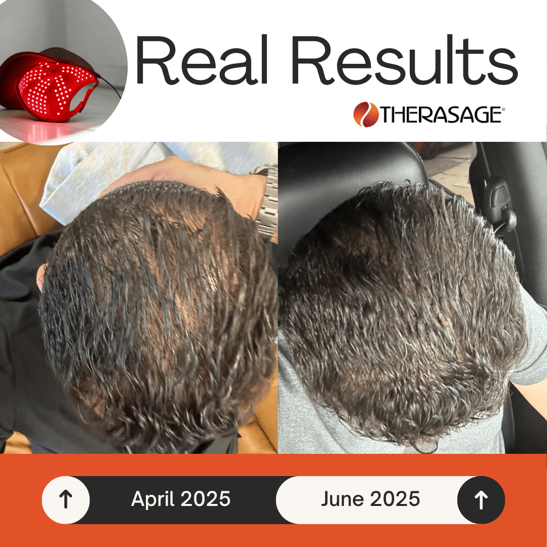 TheraCap Red Light Therapy Hair & Scalp Device - My Luxury Home Spa